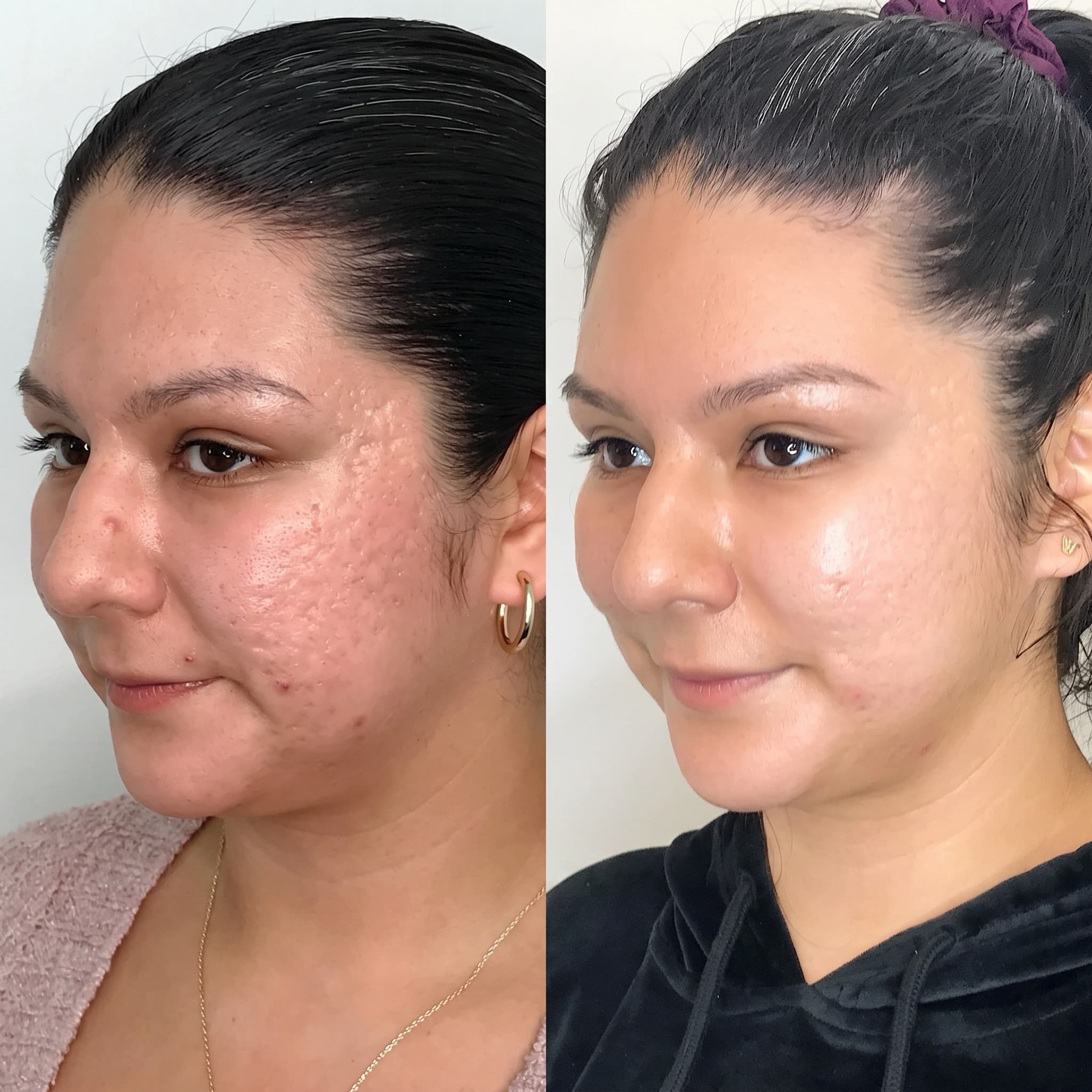 Acne Scar Removal Before & After