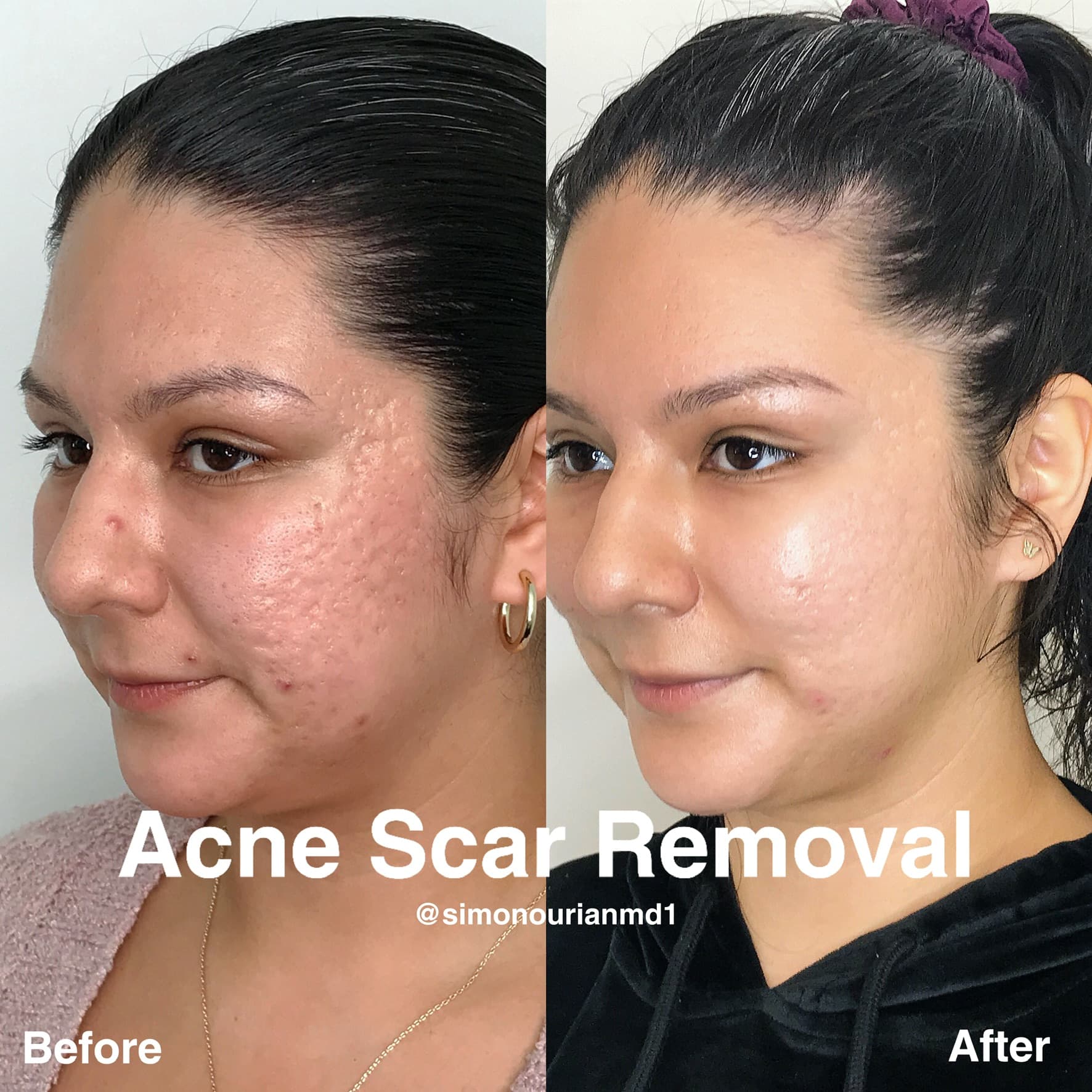 Acne Scar Removal Before & After