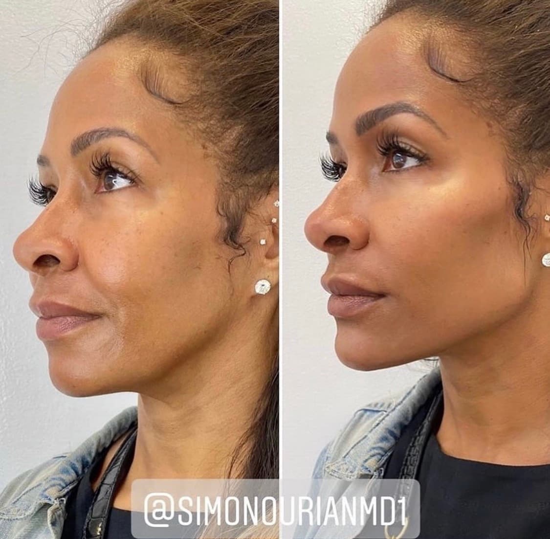 Facial Contouring Before & After