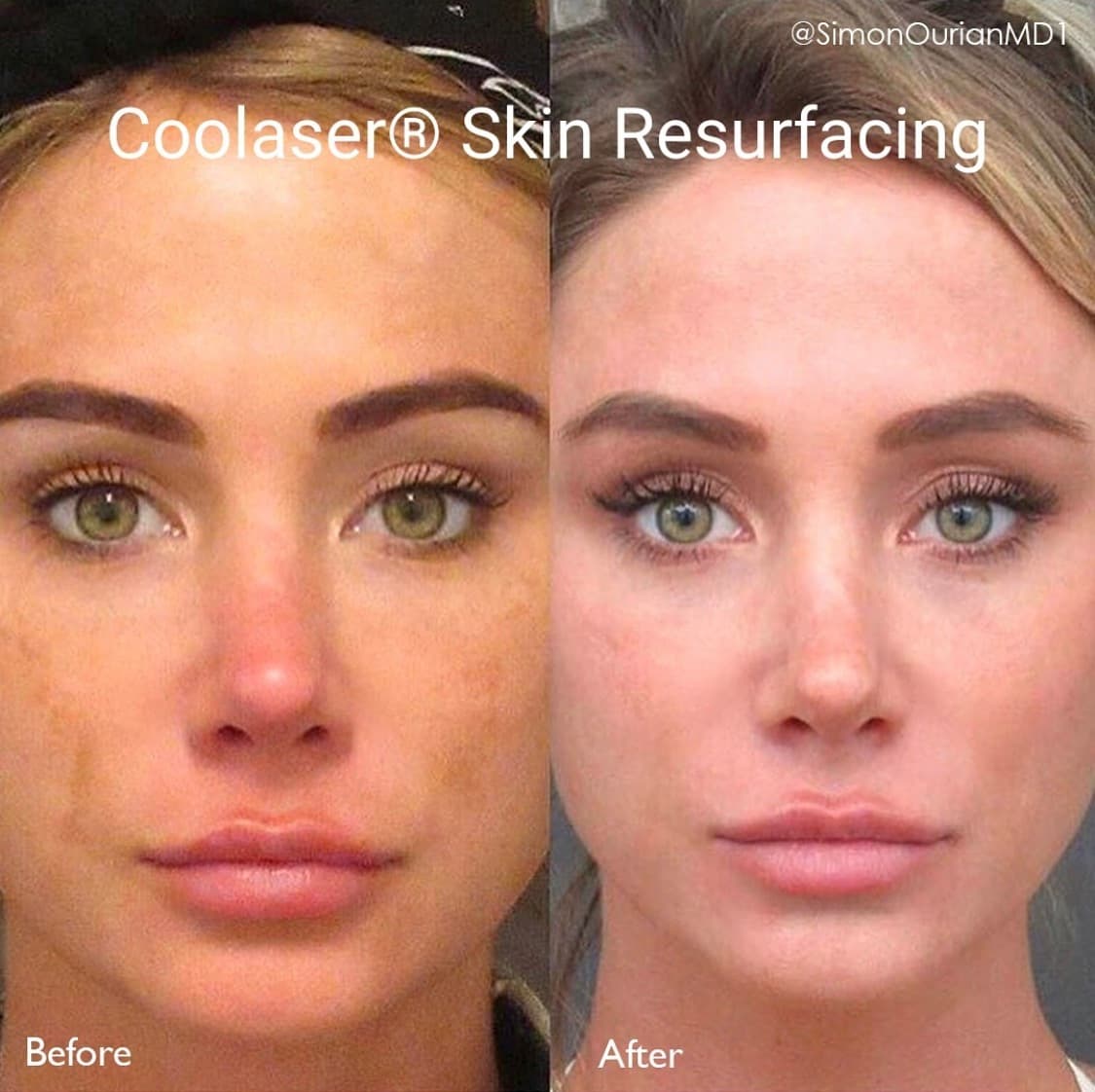 Coolaser Skin Resurfacing Before & After