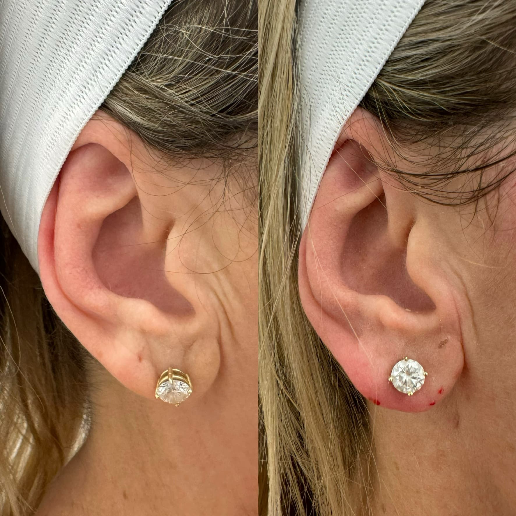 Ear Lobe Restoration Before & After