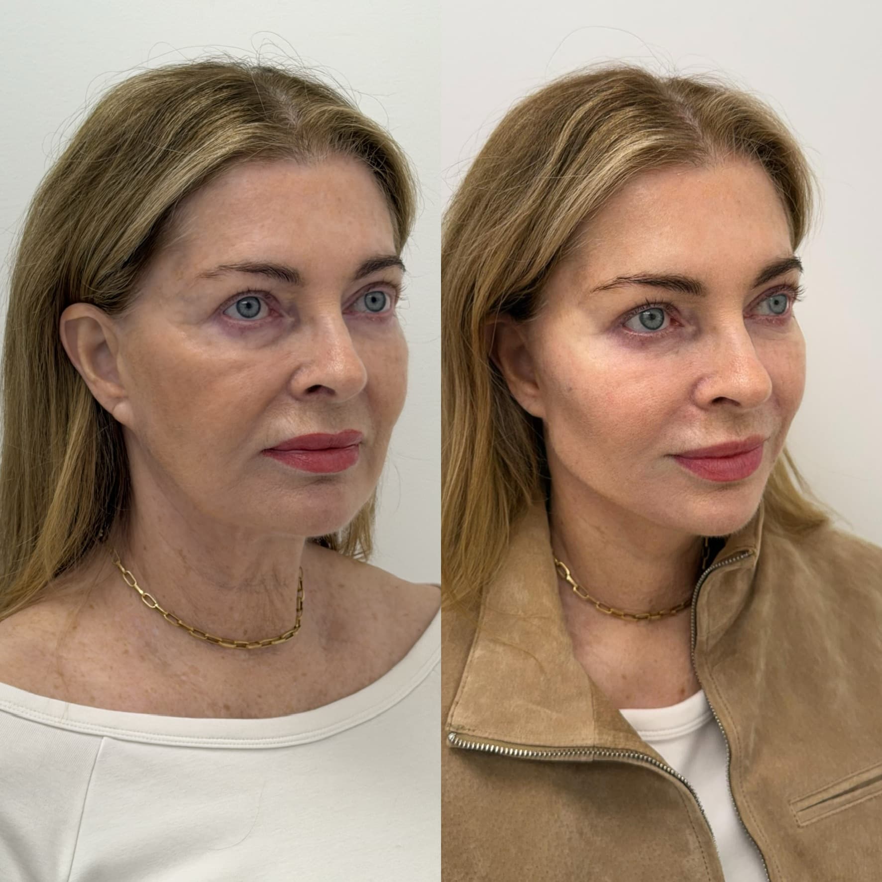 Non-Surgical Face Lift Before & After