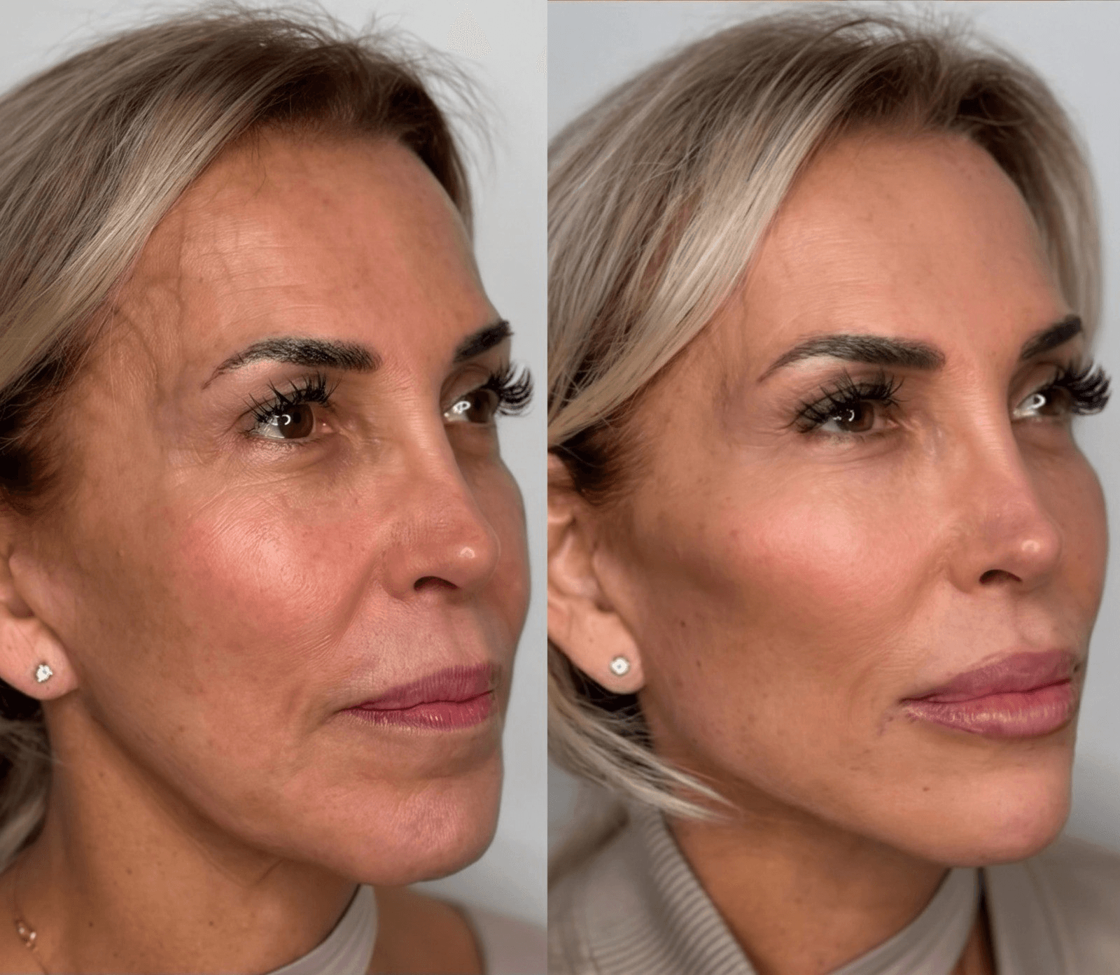 Non-Surgical Facelift & Contouring Before & After