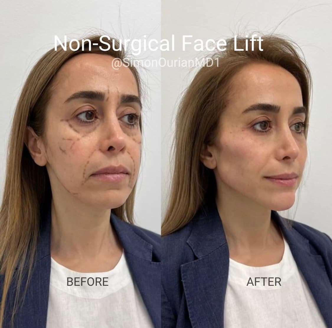 Non-Surgical Face Lift Before & After