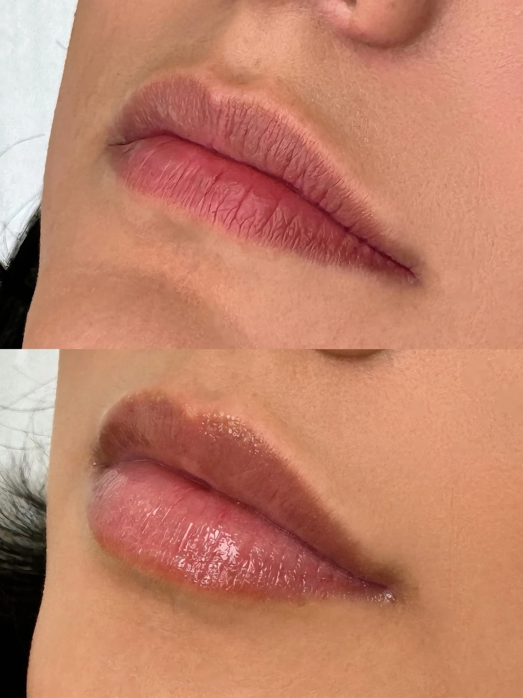 Lip Augmentation Before & After