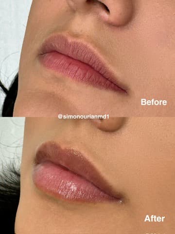 Lip Enhancement Before & After
