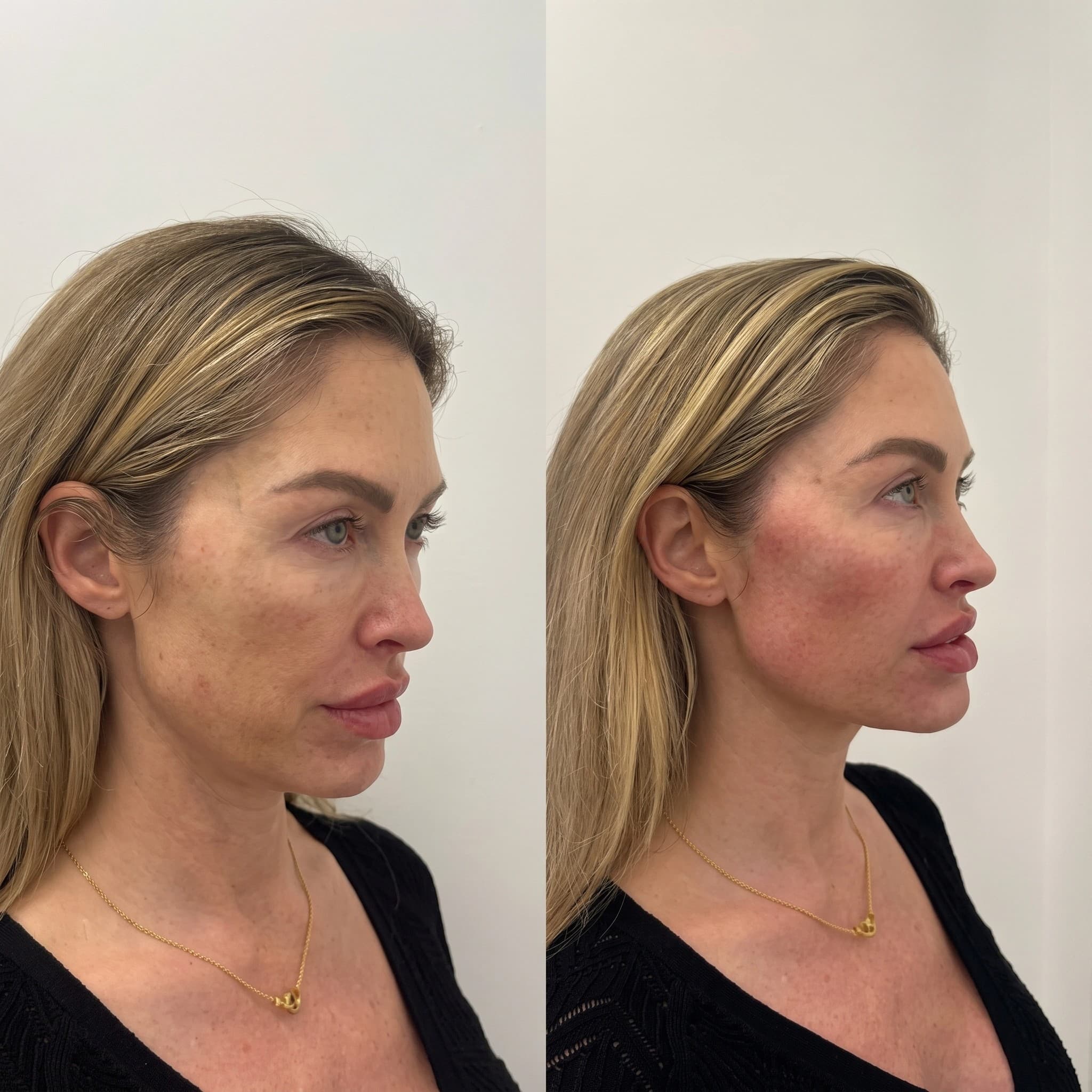 Lower Face Contouring Before & After
