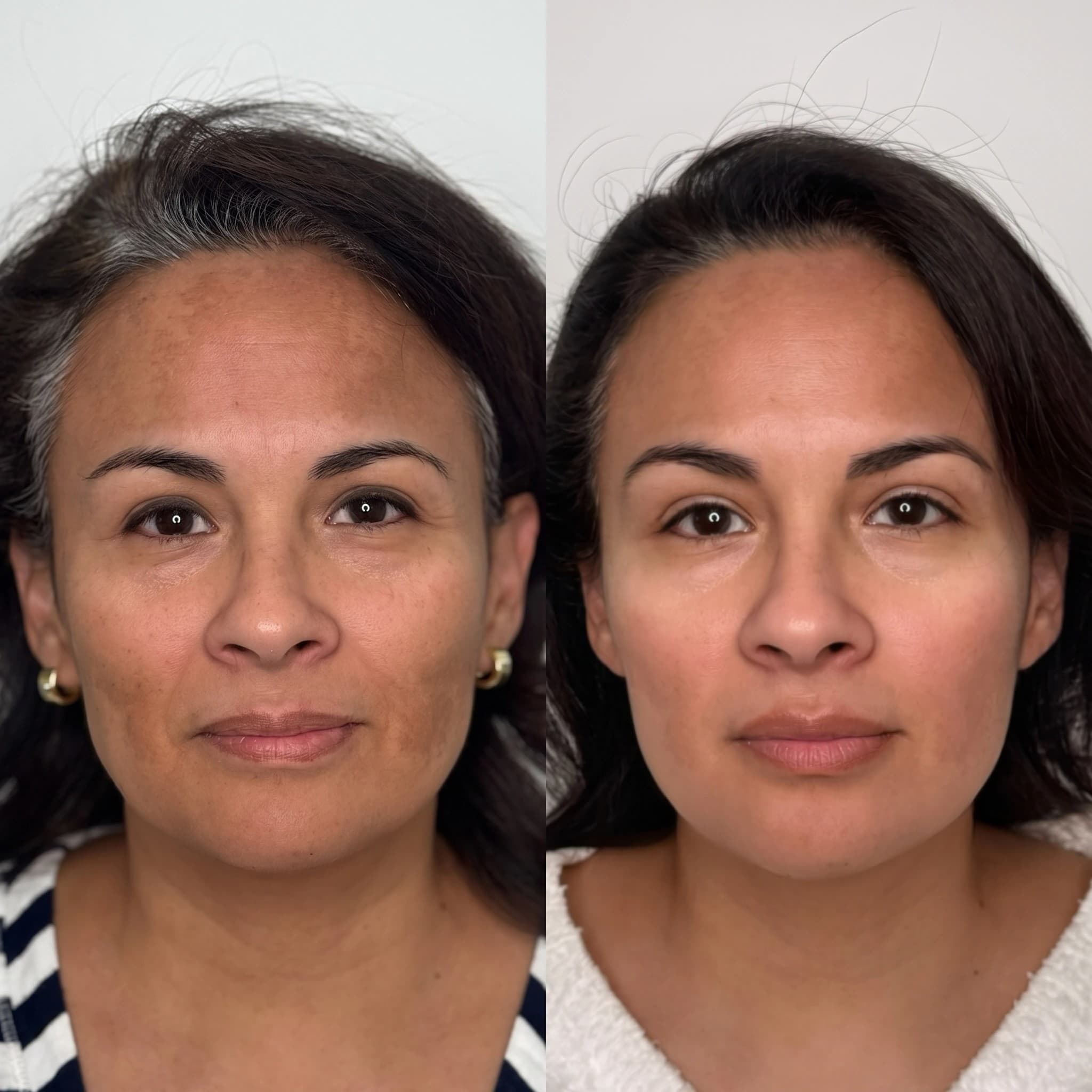Melasma & Hyperpigmentation Before & After