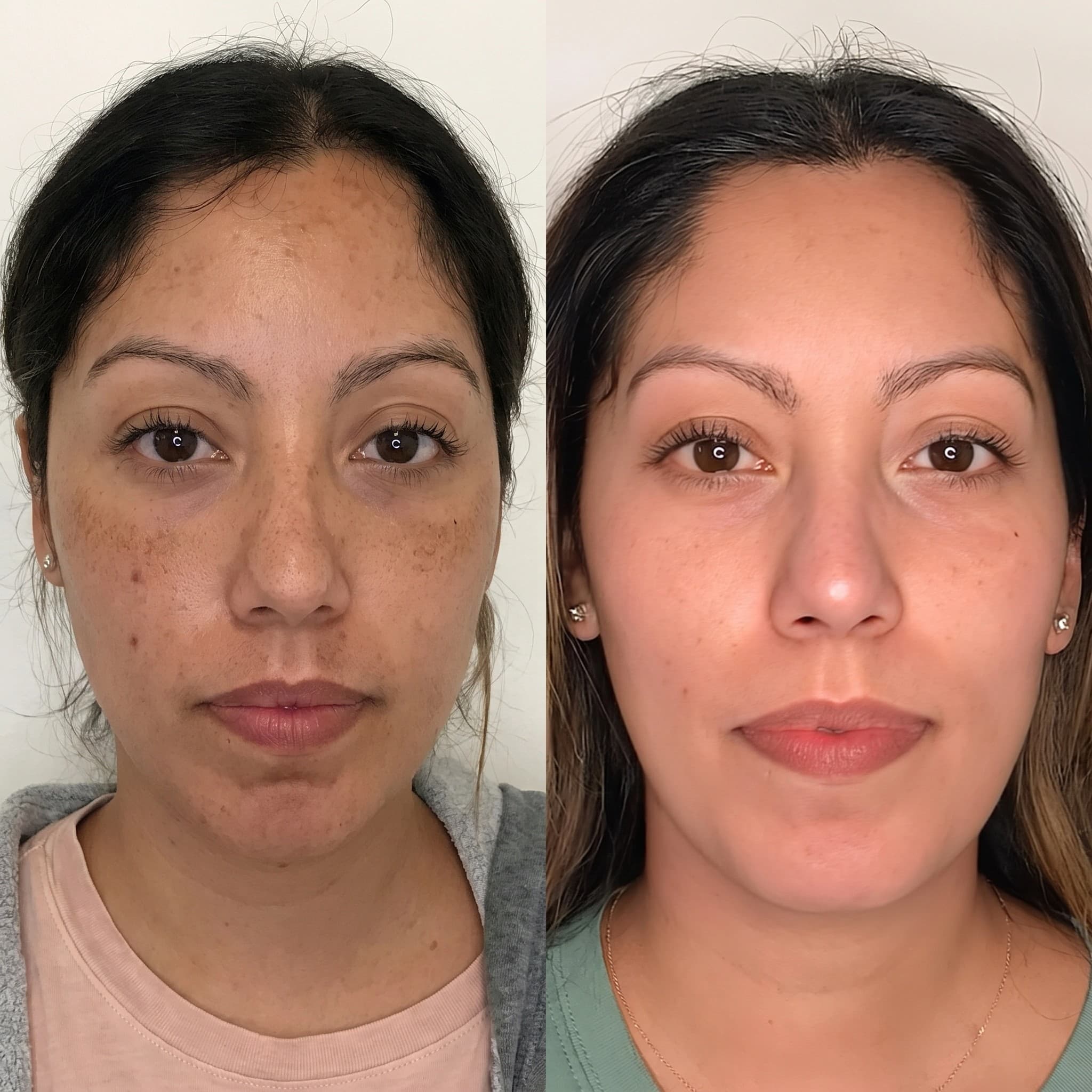 Melasma Treatment Before & After