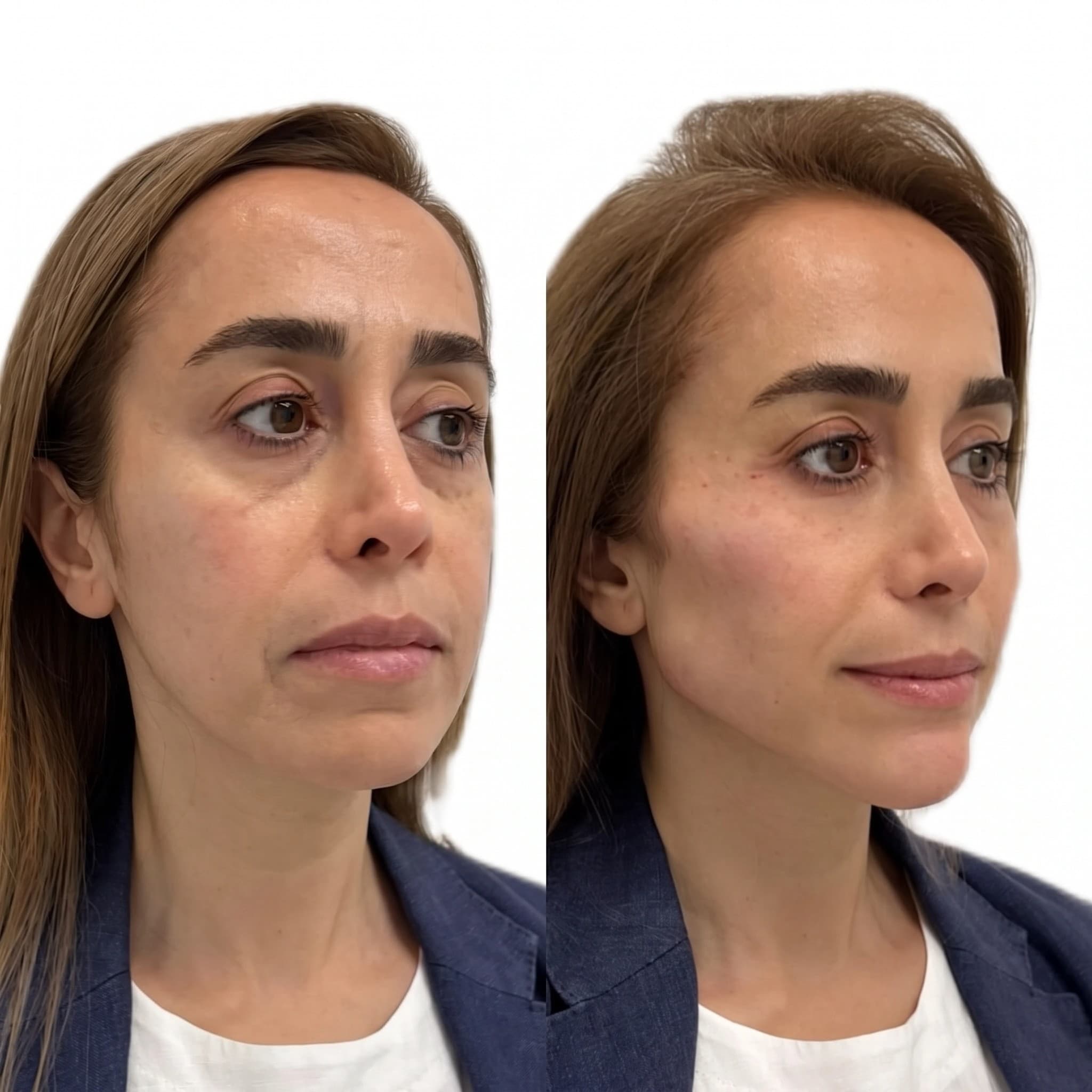 Non-Surgical Facelift & Contouring Before & After