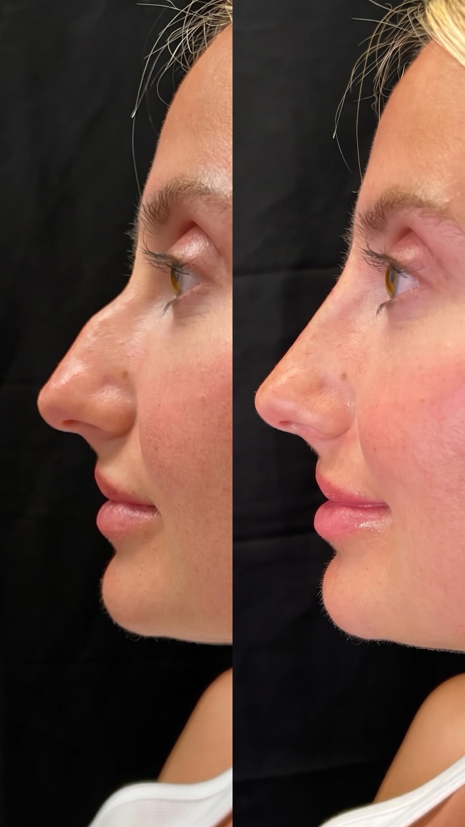 Non-Surgical Nose Job Before & After