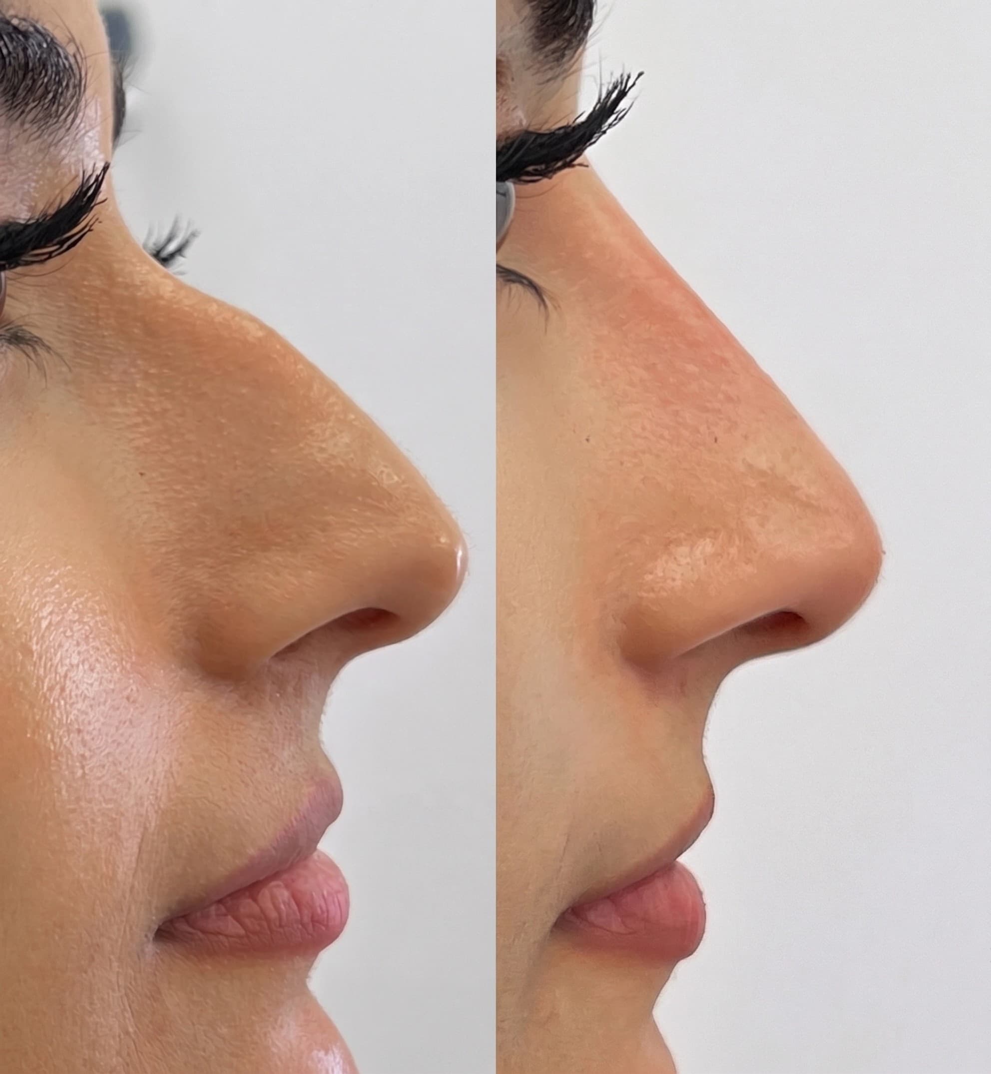 Nose Augmentation Before & After