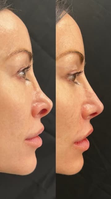 Nose Refinement Before & After