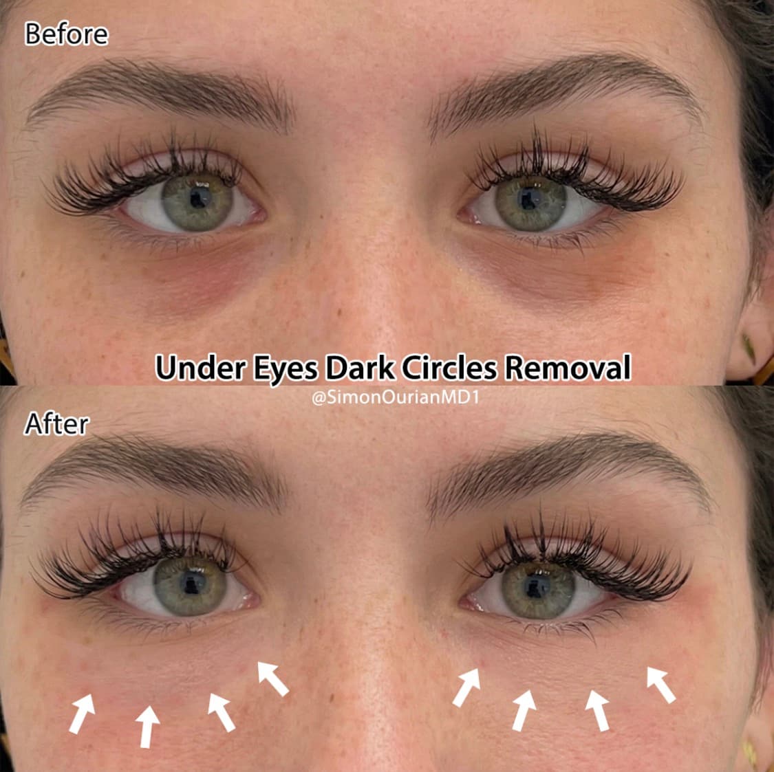 Under Eye Dark Circles Before & After